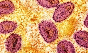 México ya tiene más de 50 casos confirmados de viruela del mono o Mpox.