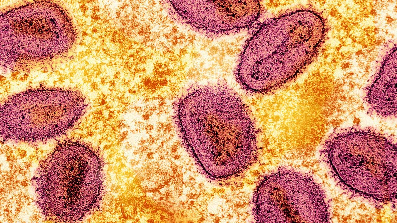 México ya tiene más de 50 casos confirmados de viruela del mono o Mpox.